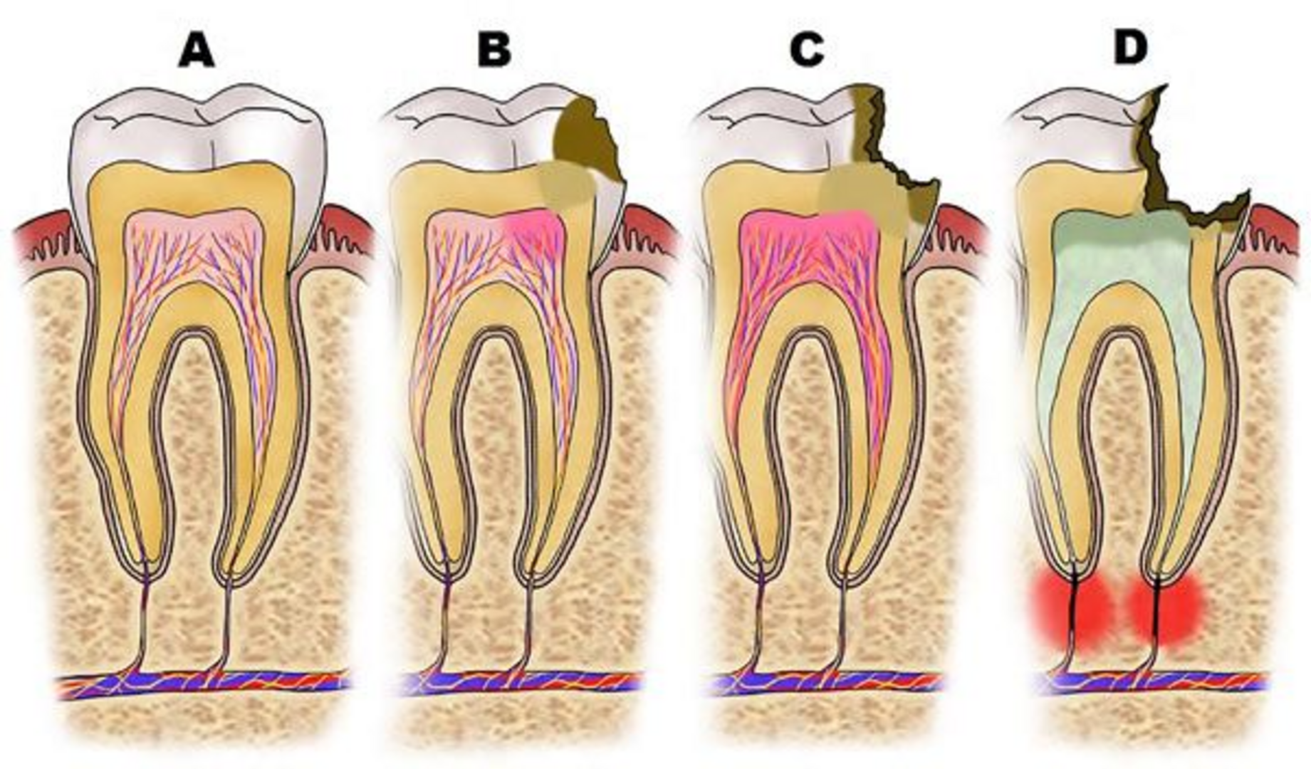 Строение зуба кариес пульпит. Кариес пульпит периодонтит. Зубы кариес пульпит периодонтит. Осложнение лечения периодонтита