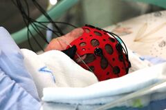 Nový EEG prístroj posilňuje starostlivosť o najmenších pacientov