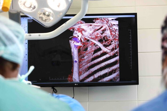 S rastúcim počtom implantácií narastá aj potreba revíznych operácií.
